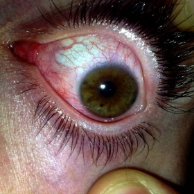 my eye