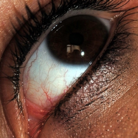 my eye